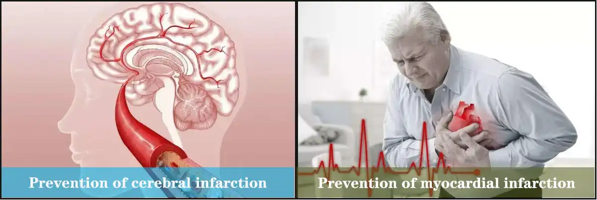 Prevention of myocardial infarction.jpg